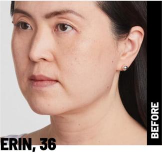 Ultherapy Before & After Patient #1544